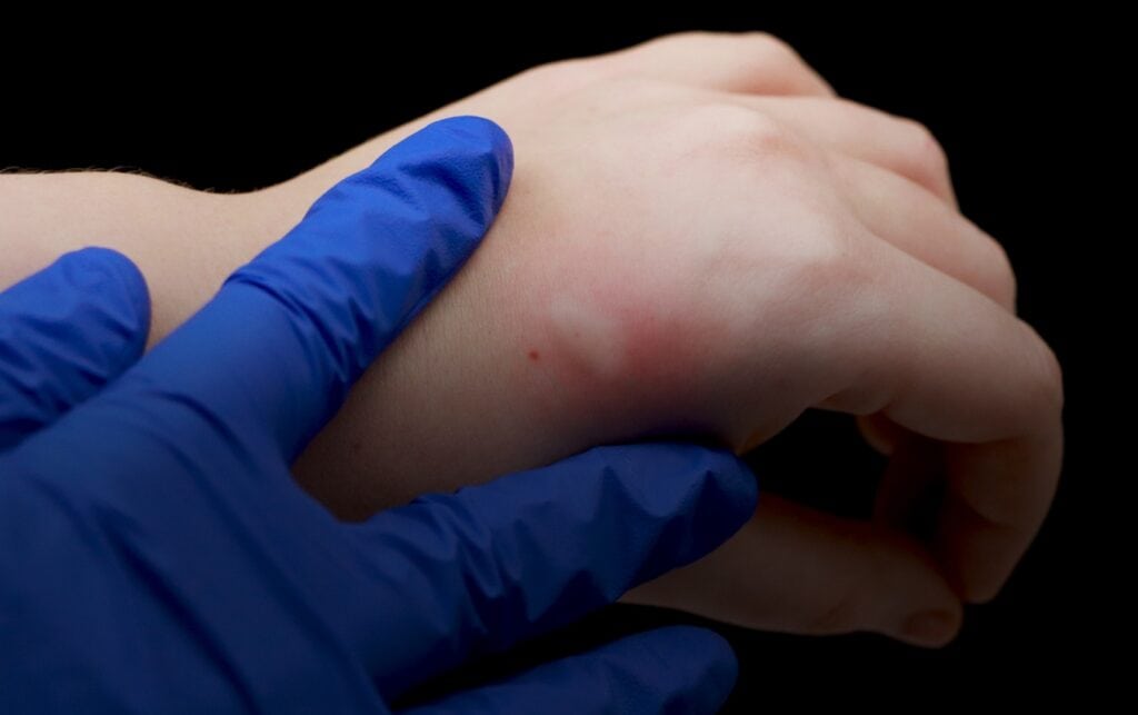 allergic reactions to nitrile gloves