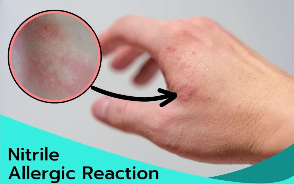 Close-up of hand with nitrile allergic reaction; red, itchy rash.