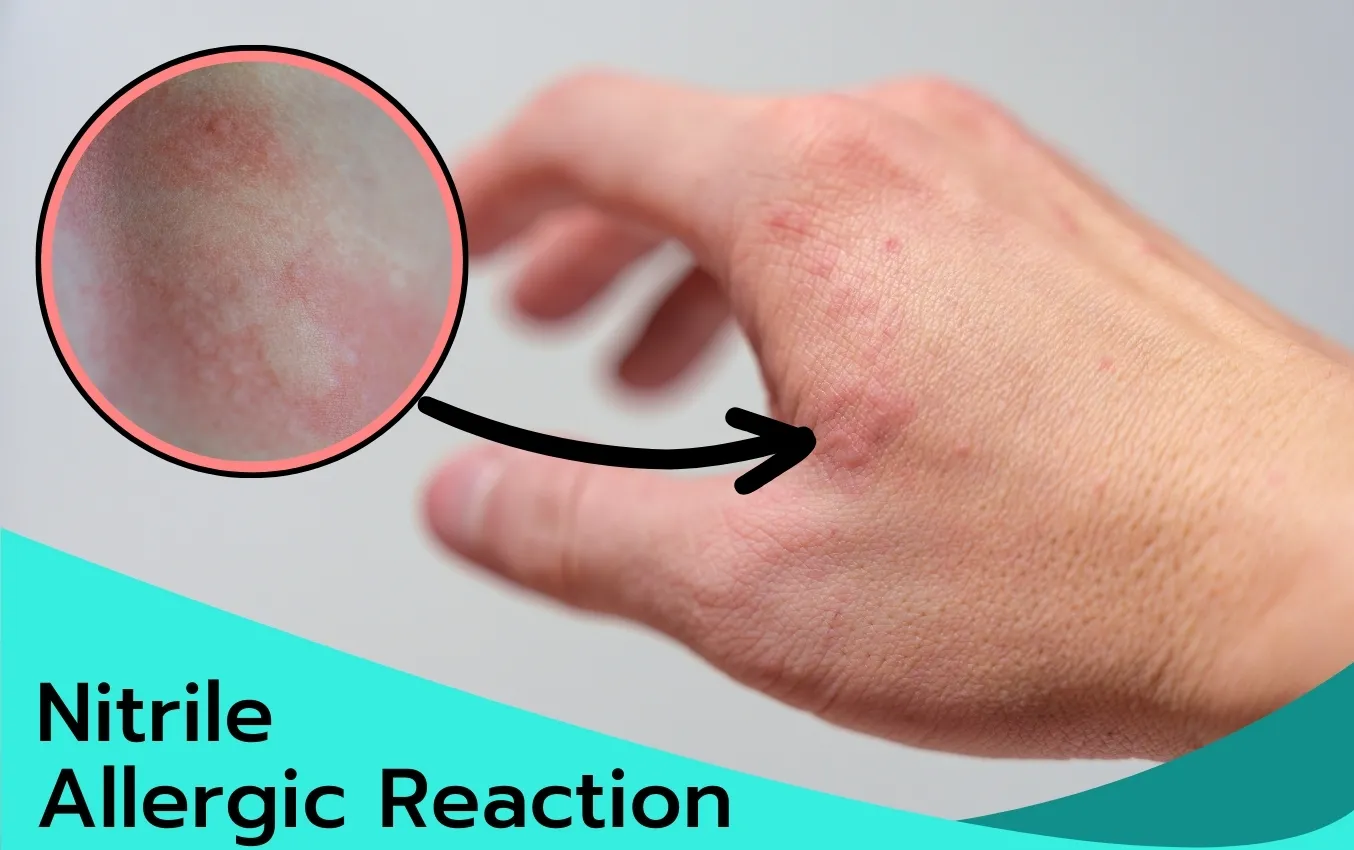 Close-up of hand with nitrile allergic reaction; red, itchy rash.