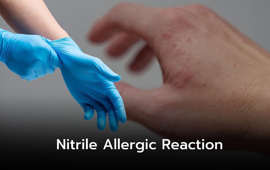 Close-up of hands; one wearing blue nitrile gloves, the other showing a nitrile allergic reaction.