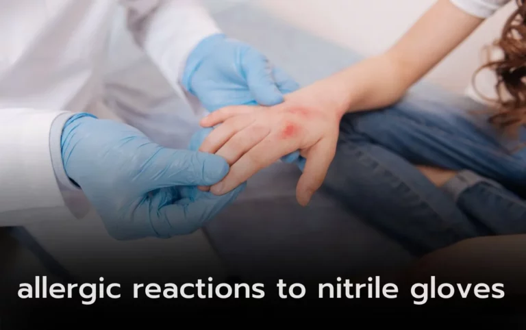 Close-up of doctor examining patient's hand with allergic reaction to nitrile gloves.