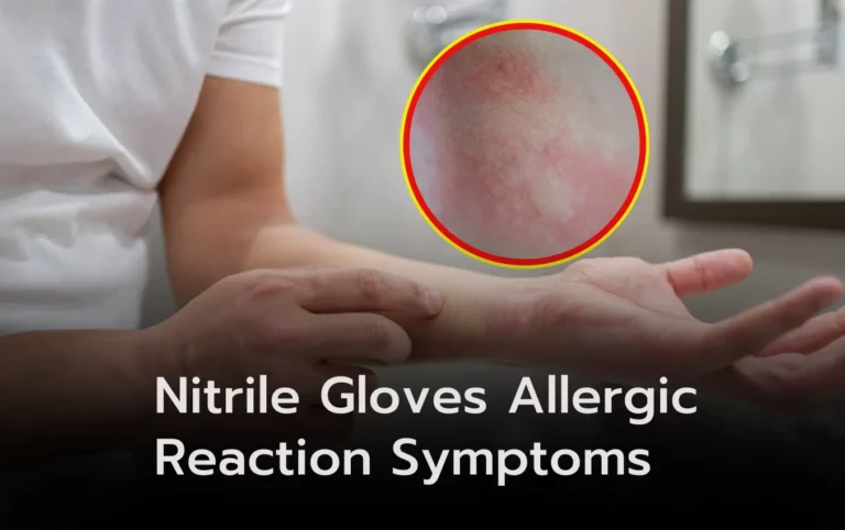 Person's arm with a nitrile gloves allergic reaction, showing redness and rash. Symptoms include hives and itching.